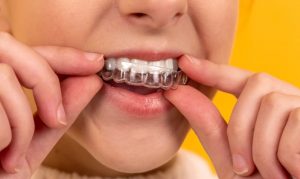 Uncovering the Modern World of Teeth Aligners